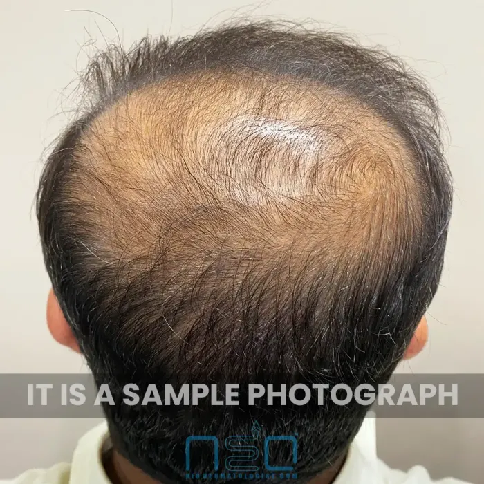 एक वास्तविक मरीज NeoDermatologist से ऑनलाइन बाल झड़ने का इलाज शुरू करने से पहले सिर के ऊपरी हिस्से में बालों के पतले होने की समस्या दिखा रहा है।