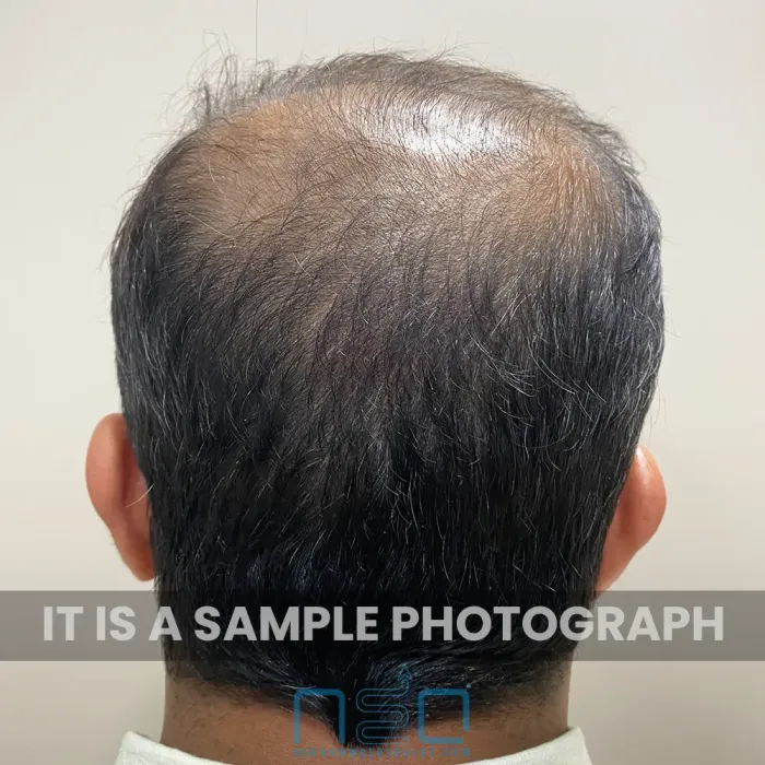 Vertex hair loss pattern in a patient who consulted NeoDermatologist for online hair loss consultation