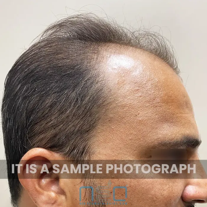 Side profile showing receding hairline in a male patient seeking online hair fall treatment from NeoDermatologist
