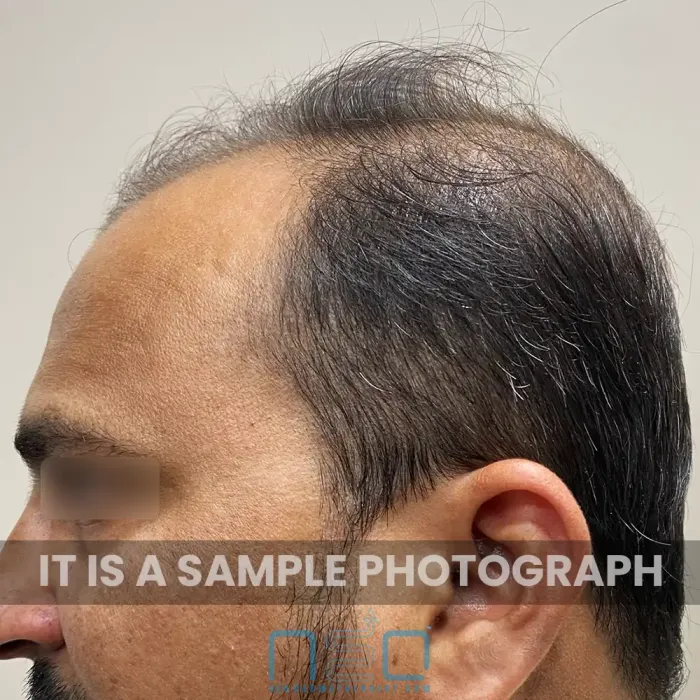 Temple area hair thinning in a patient consulting NeoDermatologist for online hair fall treatment