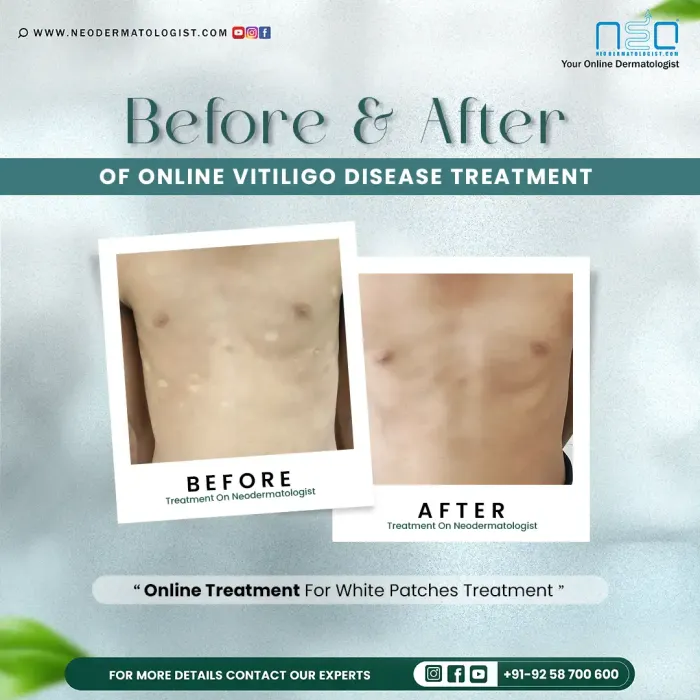 Before and after results of vitiligo white patches treatment online by a certified dermatologist at Neodermatologist.com