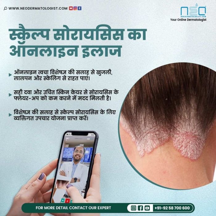 Scalp  & Plaque Psoriasis Treatment Online By Neodermatologist