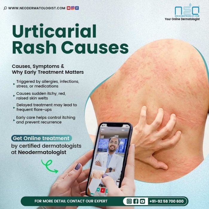 Urticarial Rash Causes - Know the Symptoms & Why Early Urticarial Rash Treatment Matters, Get Online treatment by certified dermatologists at Neodermatologist

