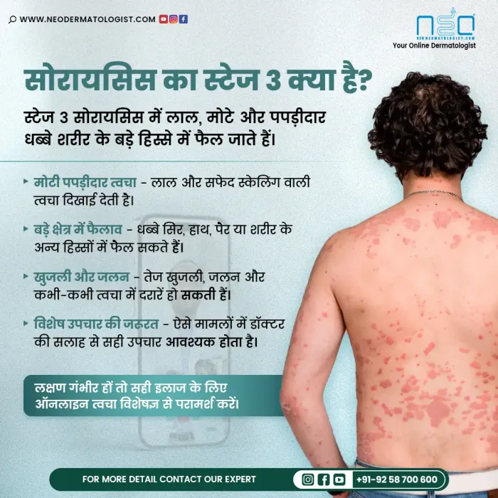 What is stage 3 psoriasis? - Dermatologist guidance and treatment