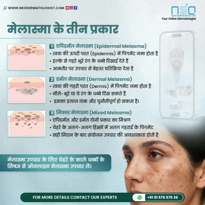 मेलास्मा के तीन प्रकारों के बारे में जानें (3 प्रकार का मेलास्मा) - त्वचा विशेषज्ञ का मार्गदर्शन और उपचार