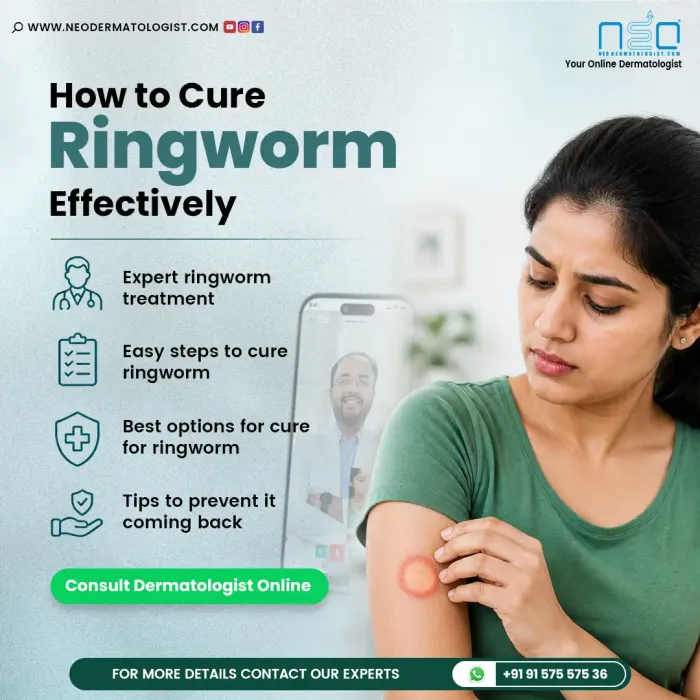 Know How to Cure Ringworm Effectively - Consult a Dermatologist Online