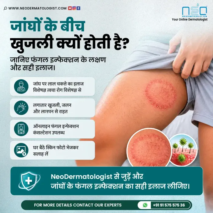 जांघों के बीच खुजली क्यों होती है? जानिए फंगल इन्फेक्शन के लक्षण और सही इलाज -  Neodermatologist
