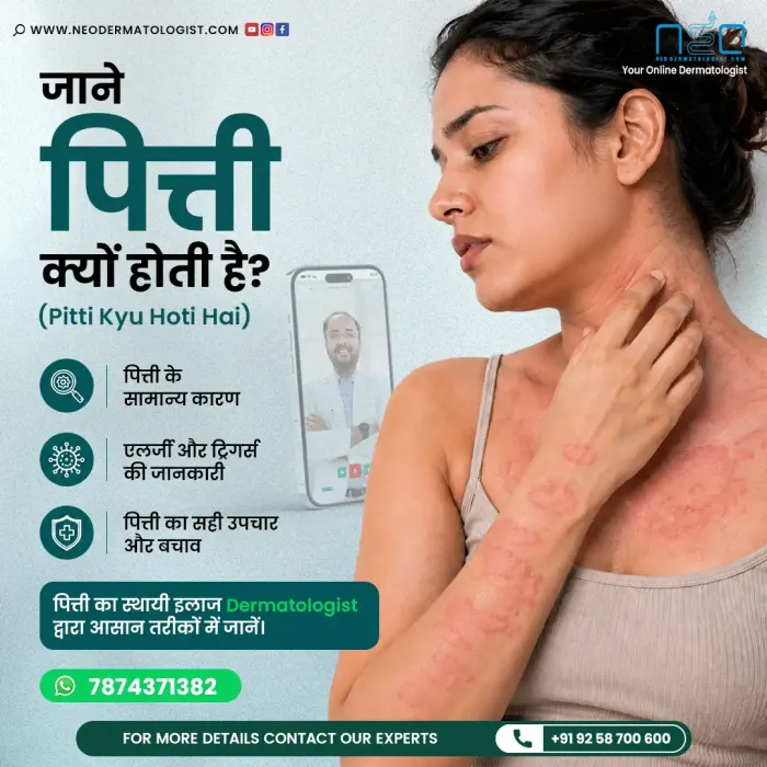 अर्टिकेरिया क्यों होता है और ऑनलाइन इलाज कैसे मदद कर सकता है - नियोडर्मेटोलॉजिस्ट (NeoDermatologist) की सलाह पढ़ें।