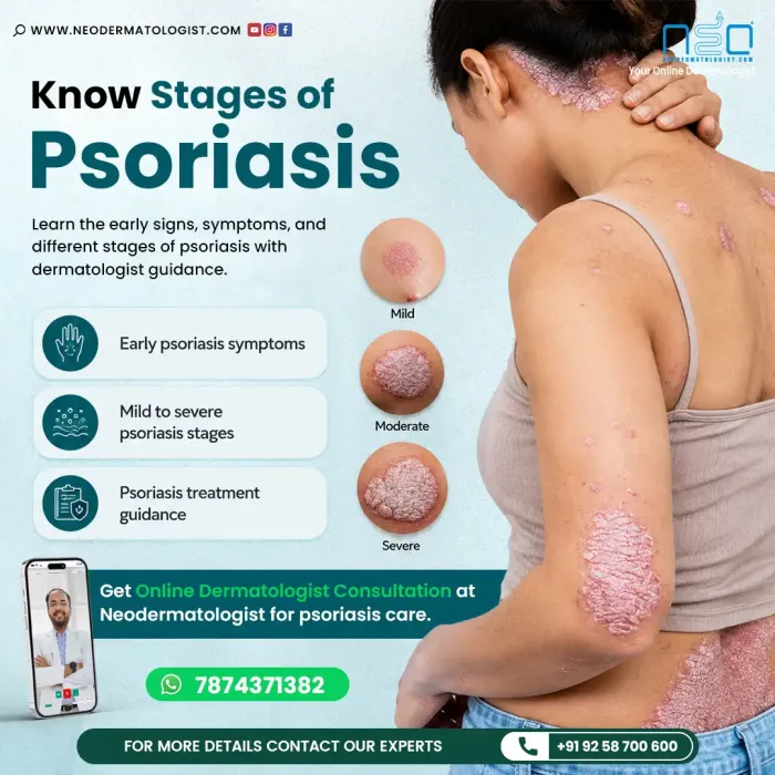 NeoDermatologist पर ऑनलाइन डर्मेटोलॉजिस्ट कंसल्टेशन के साथ सोरायसिस के हल्के से लेकर गंभीर चरणों की जानकारी।