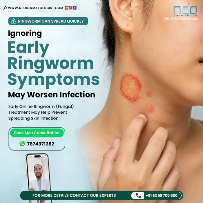 Early Ringworm Symptoms and online fungal infection treatment guidance from NeoDermatologist