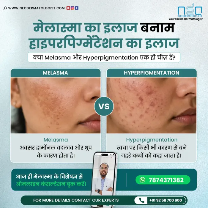 Melasma vs Hyperpigmentation - Understand the difference with expert online dermatologist guidance from NeoDermatologist