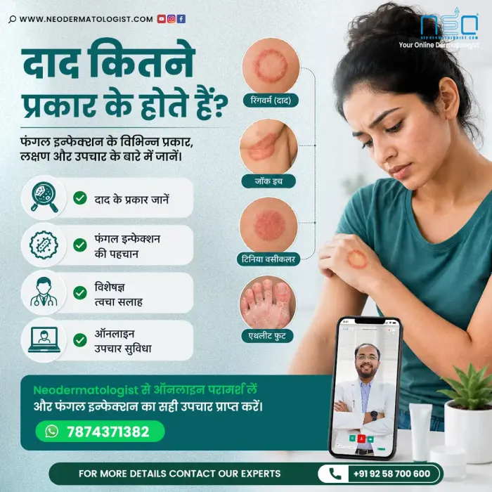जानिए दाद कितने प्रकार के होते हैं, उनके लक्षण क्या हैं, और उनके इलाज के बारे में NeoDermatologist पर विशेषज्ञ त्वचा रोग  से ऑनलाइन सलाह लें।