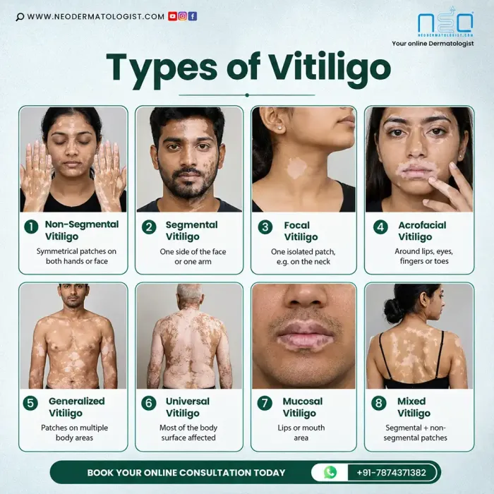 टिलिगो के प्रकार - विटिलिगो के 8 अलग-अलग प्रकार, जिनमें सफ़ेद दागों के अलग-अलग पैटर्न तस्वीरों के साथ दिखाए गए हैं - Neodermatologist गाइड