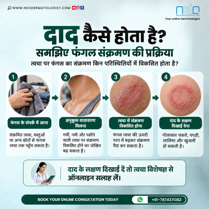 How does ringworm spread? Learn how fungal skin infections develop through infected skin contact, shared items, heat and sweating. Consult Dr. Ruchir Shah online at NeoDermatologist for ringworm diagnosis and treatment advice.