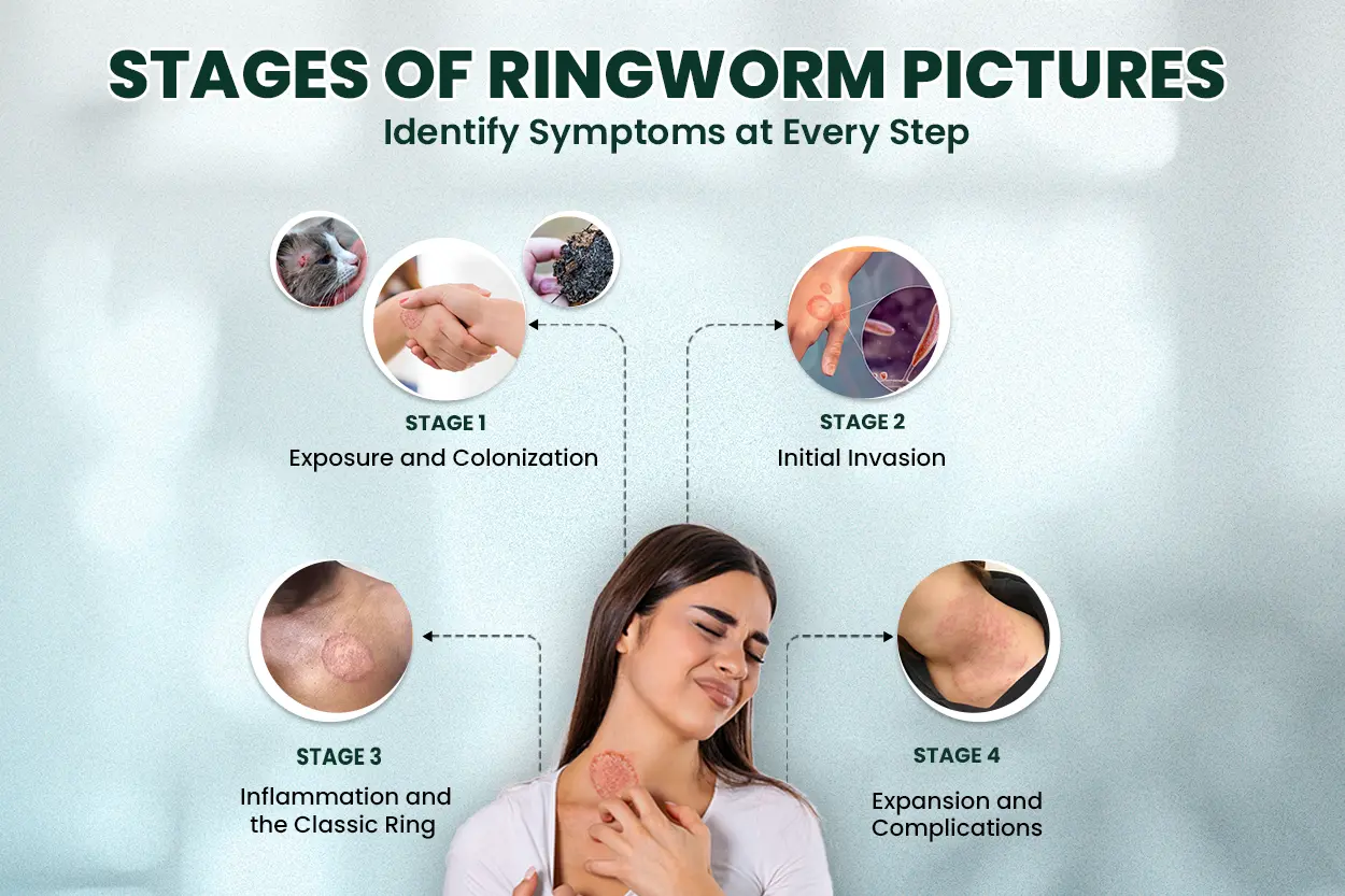 ringworm stages- explain here 4 stages of ringworm infections condition