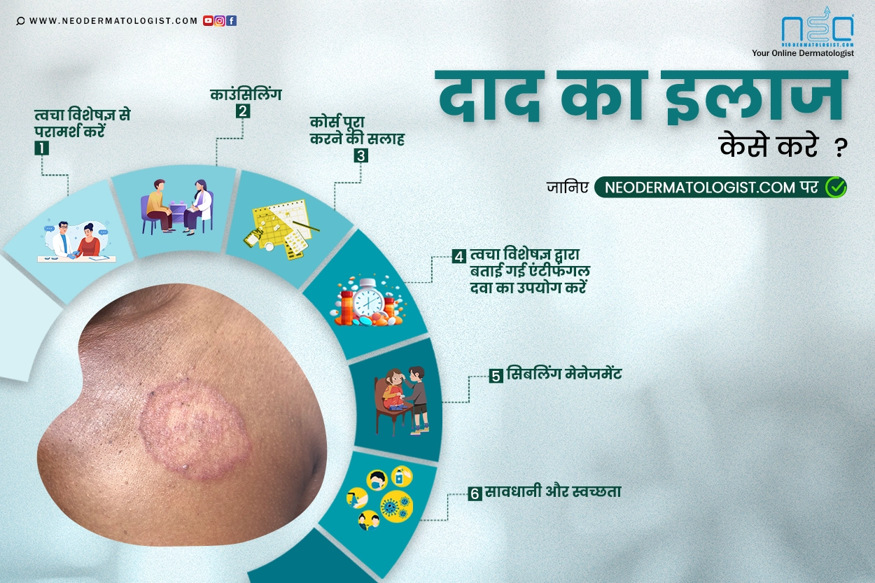 दाद का इलाज कैसे करें - दाद क्या है और इसका इलाज क्या है?