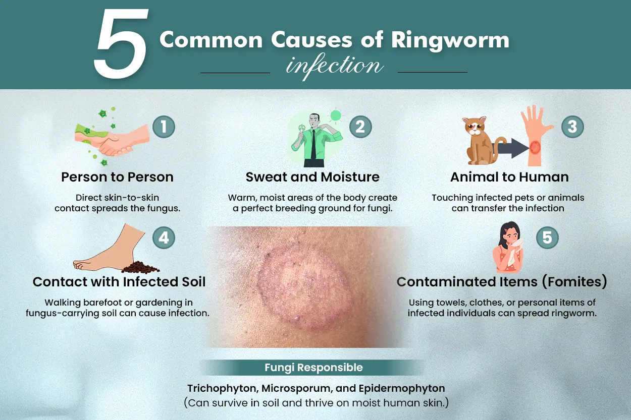 5 Causes of ringworm infection by Neodermatologist