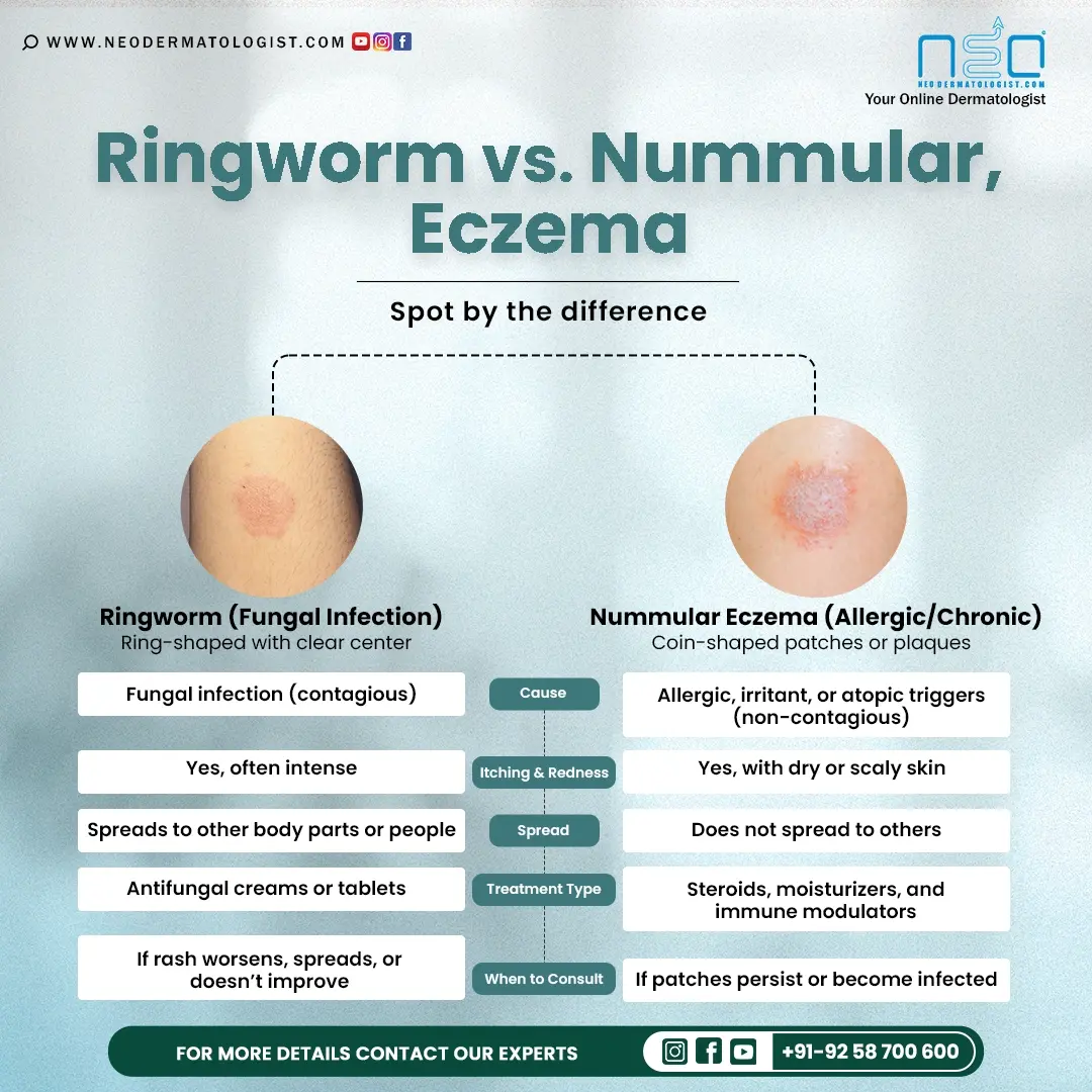 Ringworm vs Nummular Eczema: Spot the Difference