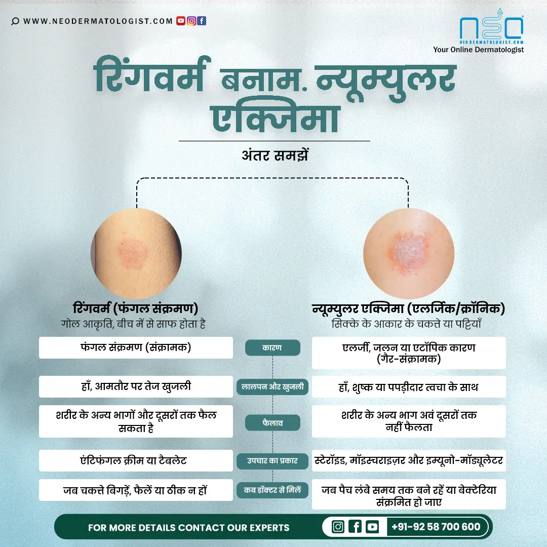 रिंगवर्म बनाम न्यूम्युलर एक्जिमा: अंतर समझें