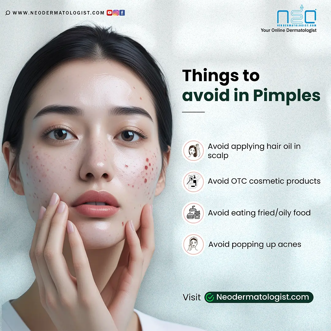 Things To Avoid In Pimples - Get Clear Skin with Online Dermatologist Consultation