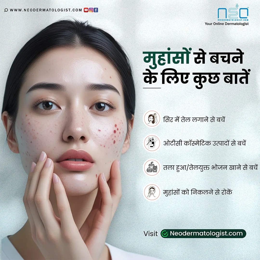 पिंपल हटाने का आसान तरीका - घर पर पिम्पल कैसे हटाएं