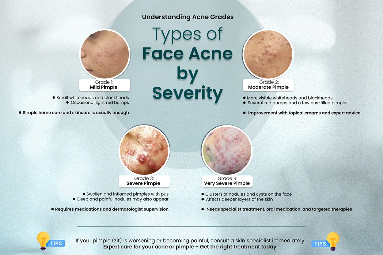 Types Of Face Acne Grades Based on Severity - Dermatologist Analysis