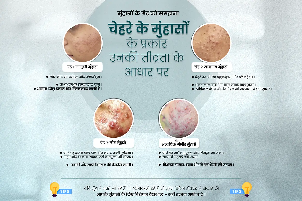 चेहरे के मुँहासों को गंभीरता के आधार पर कैसे आँकते हैं - त्वचा विशेषज्ञ  विश्लेषण 