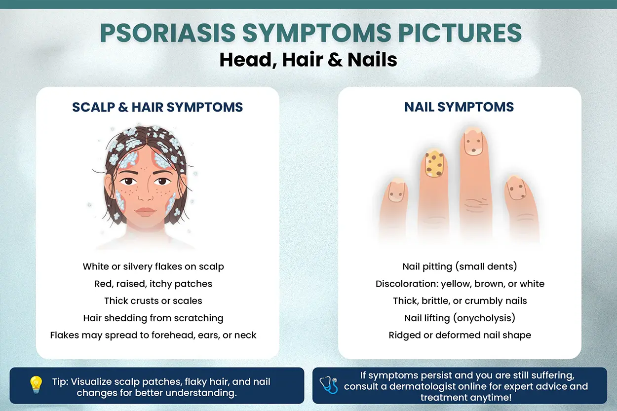 Psoriasis Symptoms Pictures  - Guide and Treatment By Neodermatologist