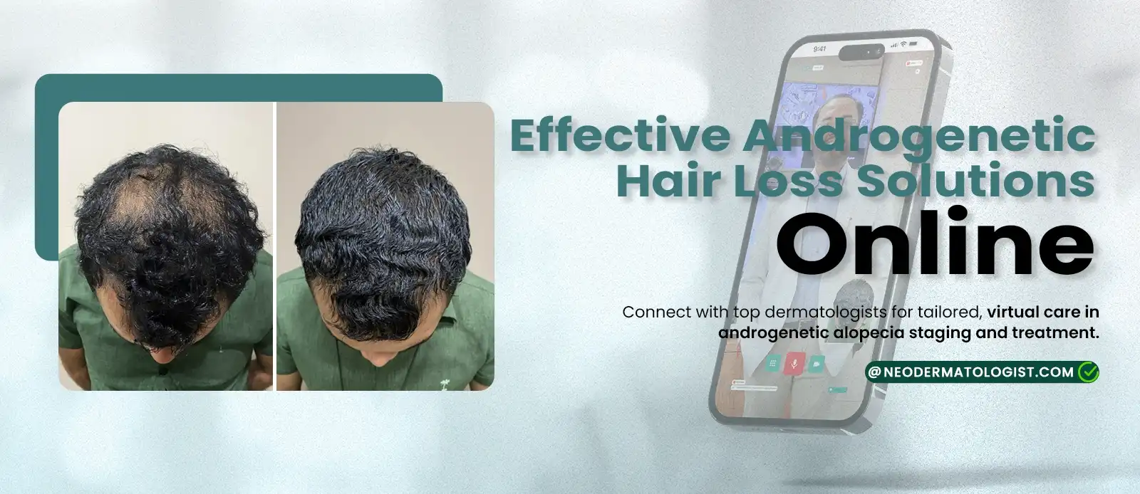 Neodermatologits.com पर हमारे एक मरीज के एंड्रोजेनेटिक एलोपेसिया (बालों के झड़ने) के उपचार के पहले और बाद के परिणाम देखें।