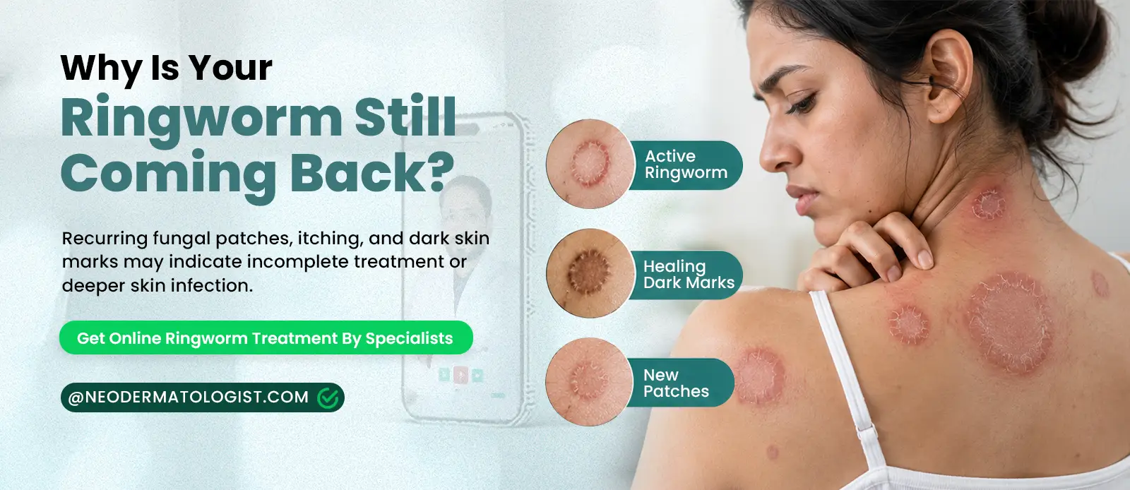 इलाज के बाद भी दाद (ringworm) वापस आ रहा है? NeoDermatologist से फंगल इन्फेक्शन का एक्सपर्ट ऑनलाइन इलाज लें।