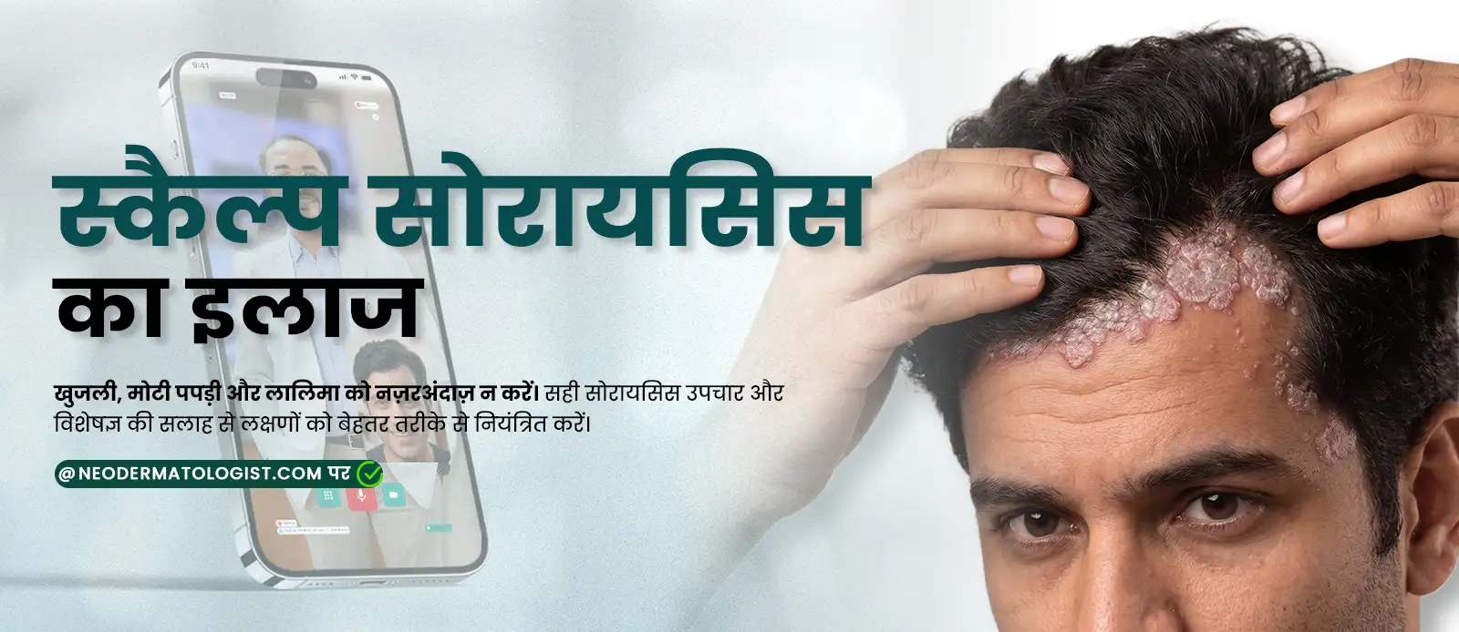 Get Scalp Psoriasis Treatment Online - Expert care for itchy scalp, thick scales, and redness.