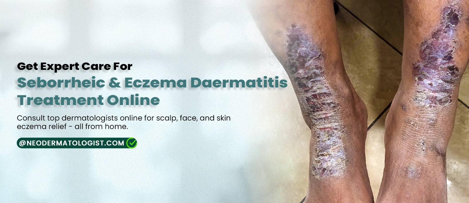 Seborrheic & Eczema Dermatitis Treatment Online - Consult top dermatologists online for scalp, face, and skin eczema relief