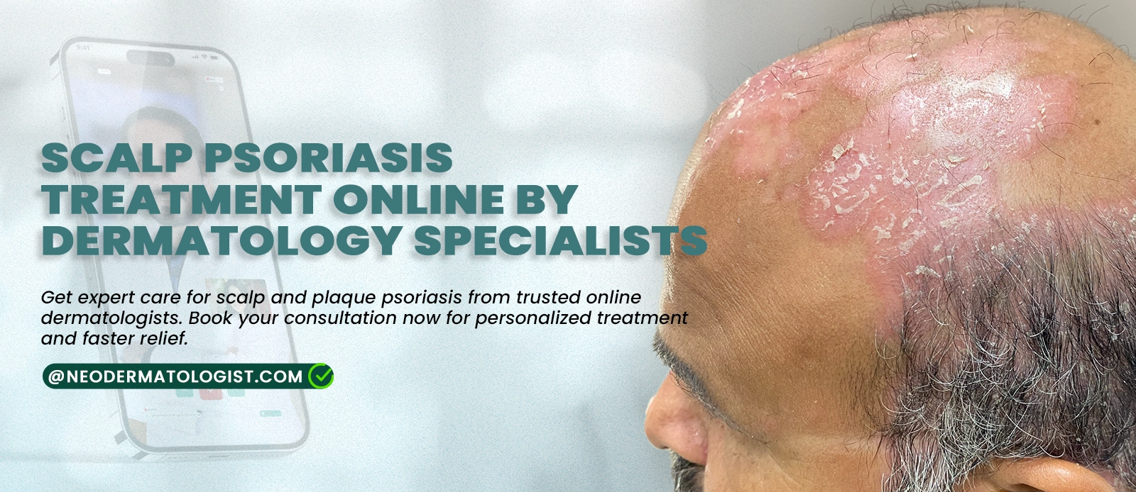 Scalp Psoriasis Treatment Online by Dermatology Specialists