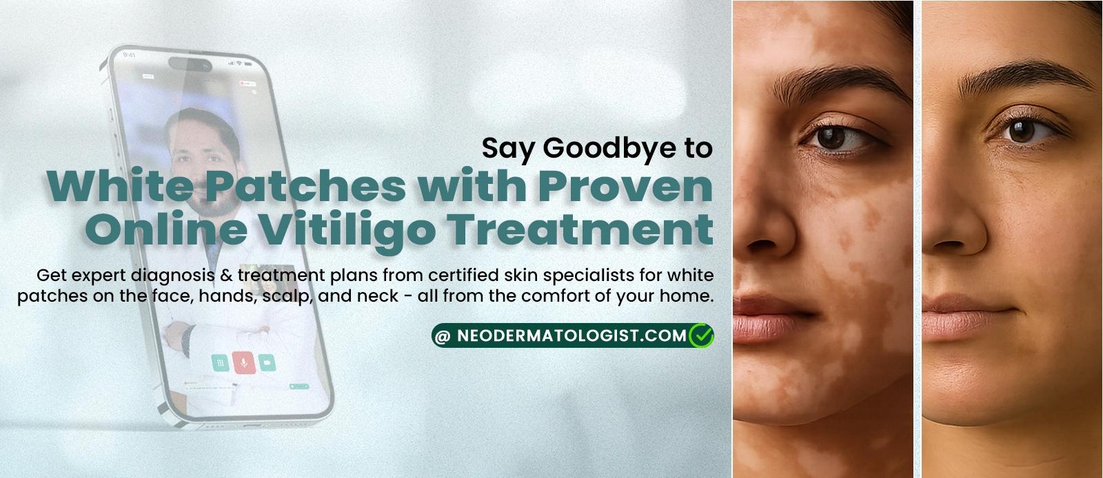 If You Have White Patches on face, nose, neck, hand, get expert dermatologist help from a dermatologist for Proven Online Vitiligo Treatment