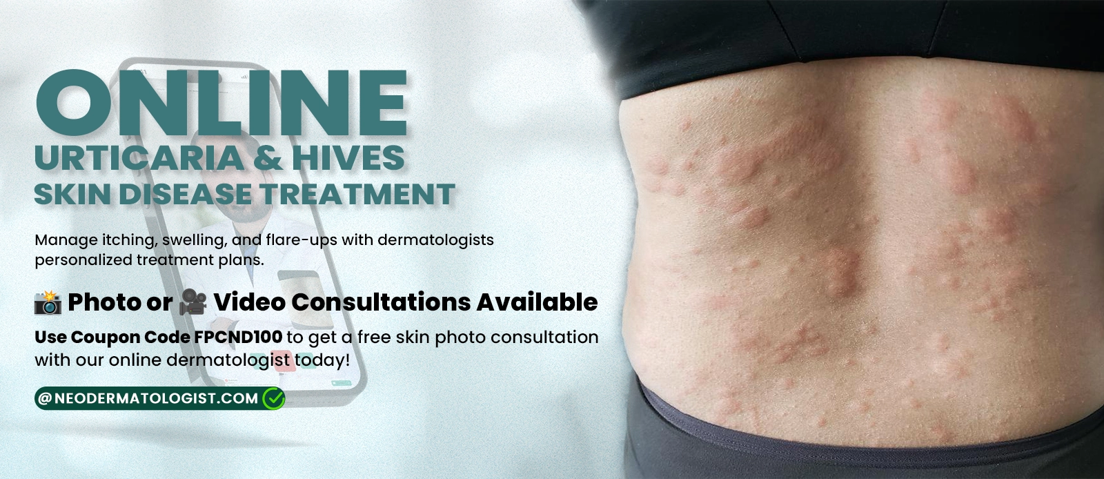 Online Urticaria & Hives Skin Disease Treatment - Manage itching, swelling, and flare-ups with personalized treatment plans from dermatologists.