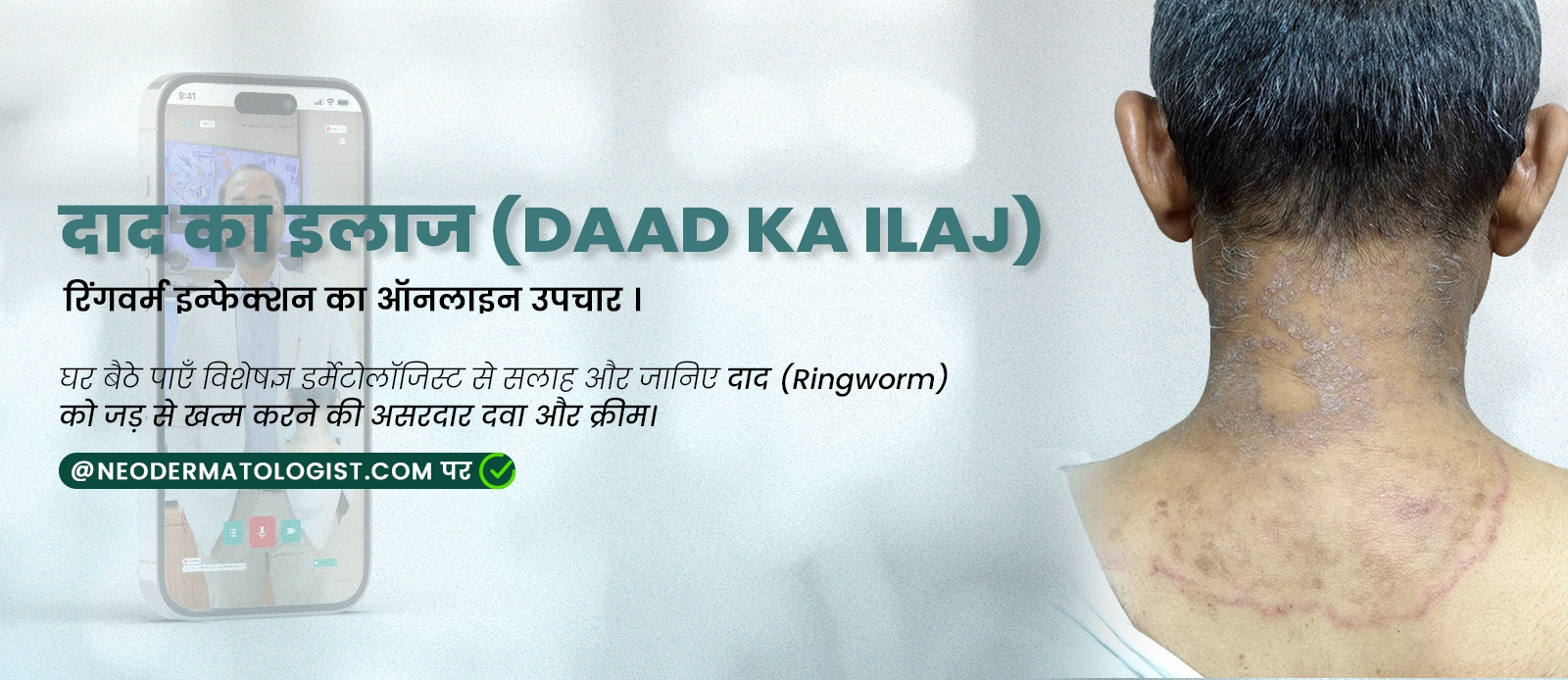 दाद का इलाज (Online Daad Ka Ilaj) - रिंगवर्म इन्फेक्शन का ऑनलाइन उपचार