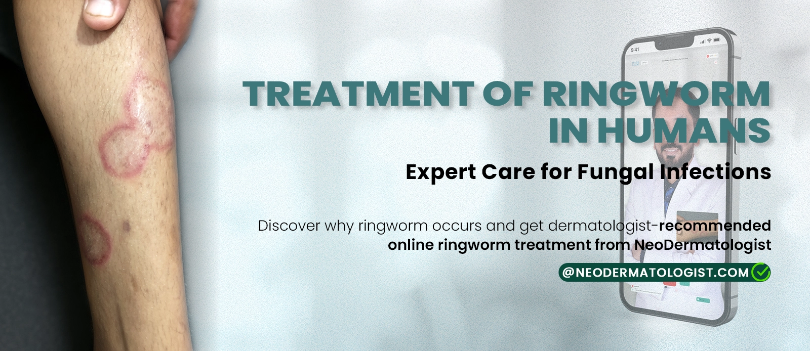 Treatment of Ringworm in Humans - Expert Care for Fungal Infections at Neodermatologist