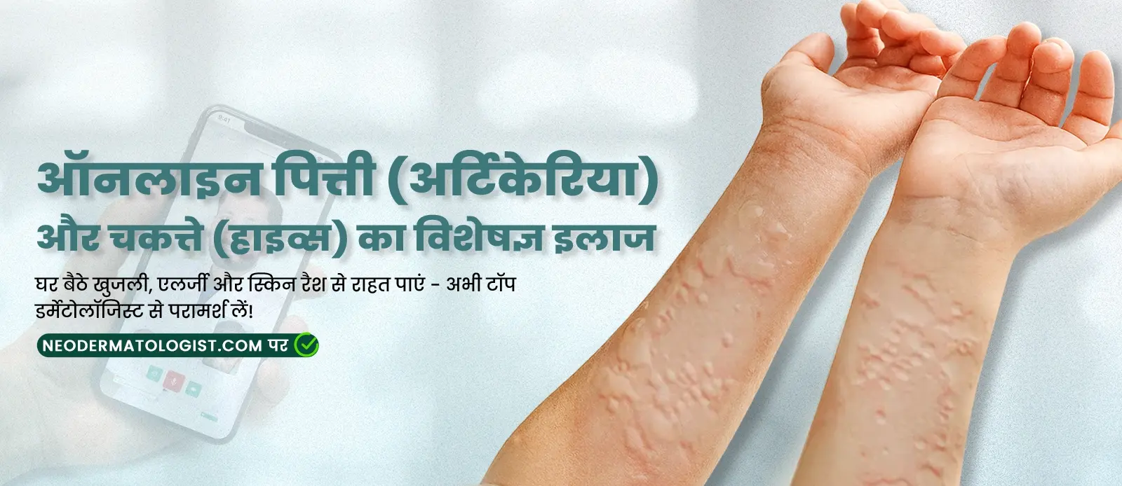 ऑनलाइन पित्ती (अर्टिकेरिया) और चकत्ते (हाइव्स) का विशेषज्ञ इलाज 
