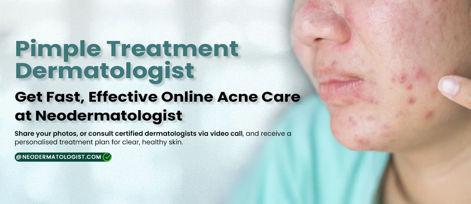 ऑनलाइन पिंपल्स कंसल्टेशन - डर्मेटोलॉजिस्ट से एक्ने ट्रीटमेंट At Neodermatologist