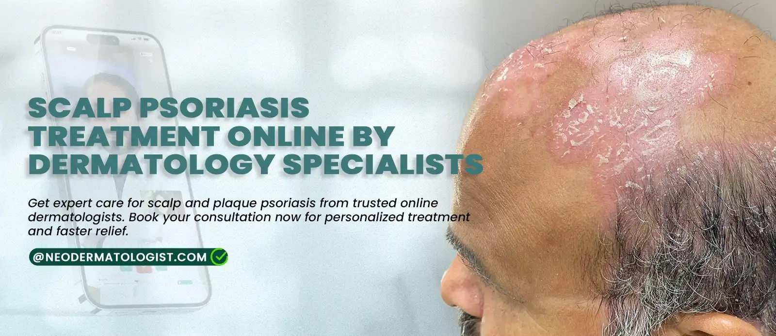 Scalp Psoriasis Treatment Online by Dermatologist Specialists - Neodermatologist