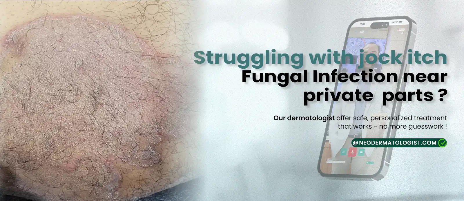  Jock itch fungal infection near private parts - Consult an expert dermatologist online for tinea cruris treatment 