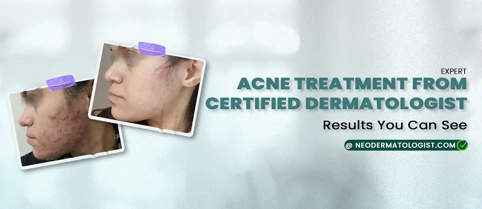 Acne Treatment From a Dermatologist - Our client results, Online dermatologist consultation for Acne or Pimple Treatment