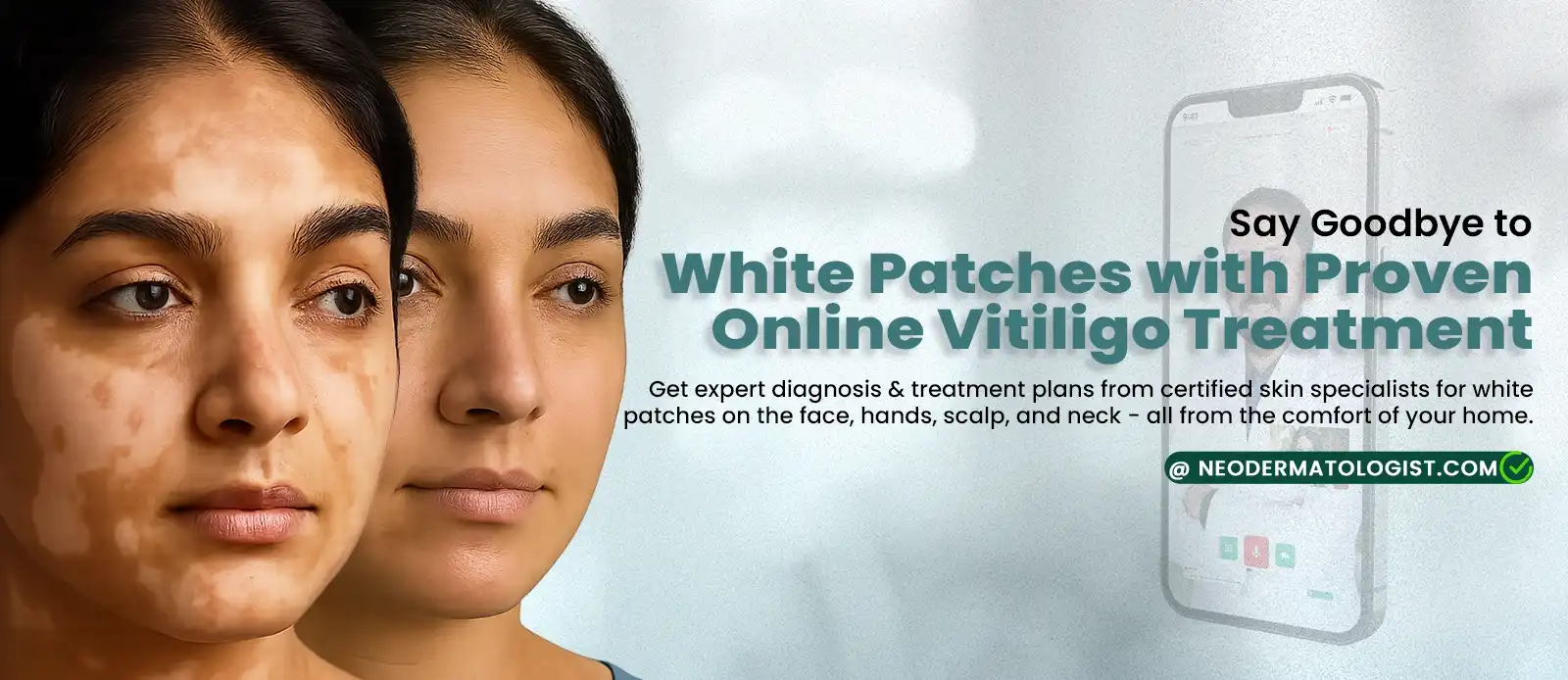 If You Have White Patches on face, nose, neck, hand, get expert dermatologist help from a  dermatologist for Proven Online Vitiligo Treatment
