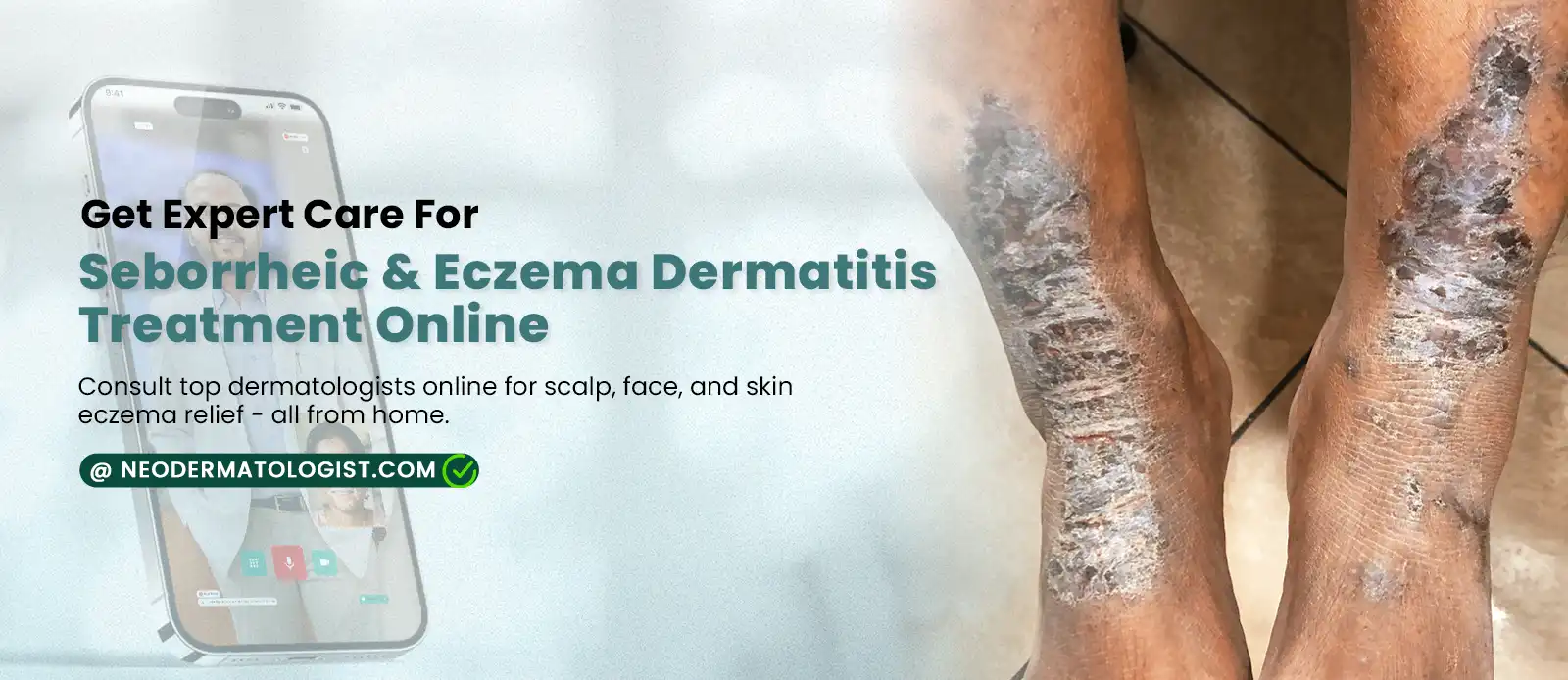  Seborrheic & Eczema Dermatitis Treatment Online - Consult top dermatologists online for scalp, face, and skin eczema relief at Neodermatologist