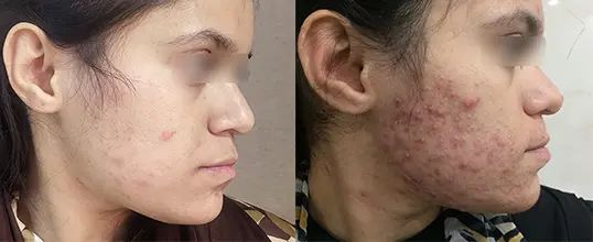 एक्ने या पिंपल उपचार के लिए Neodermatologist पर ऑनलाइन त्वचा विशेषज्ञ से परामर्श