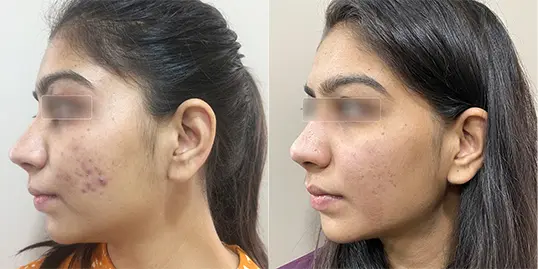 Neodermatologist पर प्रमाणित त्वचा विशेषज्ञों द्वारा ऑनलाइन मुंहासे और पिंपल का उपचार