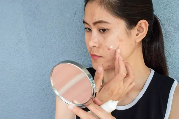 Online Acne or pimple treatment from a  dermatologist
