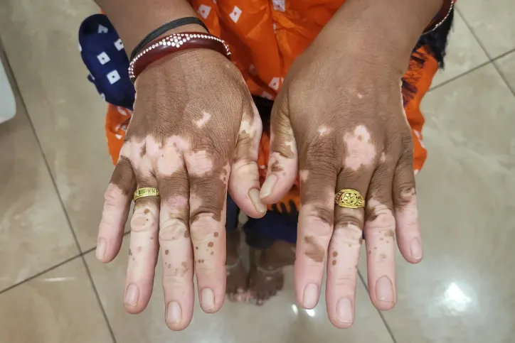त्वचा विशेषज्ञ द्वारा त्वचा पर सफेद धब्बों की जांच, विटिलिगो के उपचार के लिए परामर्श
