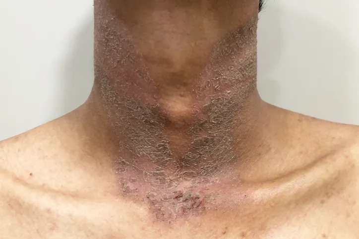 स्कैल्प और प्लाक सोरायसिस विशेषज्ञ - ऑनलाइन डर्मेटोलॉजिस्ट परामर्श उपचार - स्कैल्प सोरायसिस का इलाज