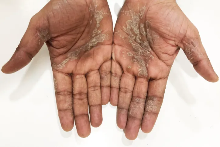 NeoDermatologist का प्लाक और स्कैल्प सोरायसिस ऑनलाइन उपचार